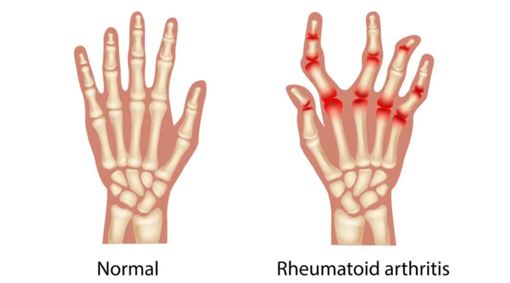 Rheumatoid Arthritis